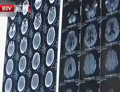 世界卒中日：卒中發(fā)病呈年輕化趨勢